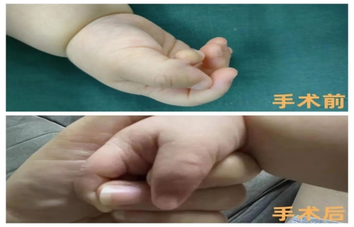 六个月宝宝“特殊多指”，德州扑克游戏网
巧解难题
