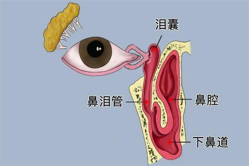 孩子总是“泪眼汪汪”，可能是泪道阻塞了！